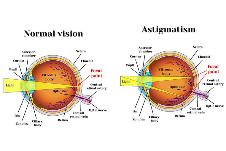 viziune cu astigmatism mixt